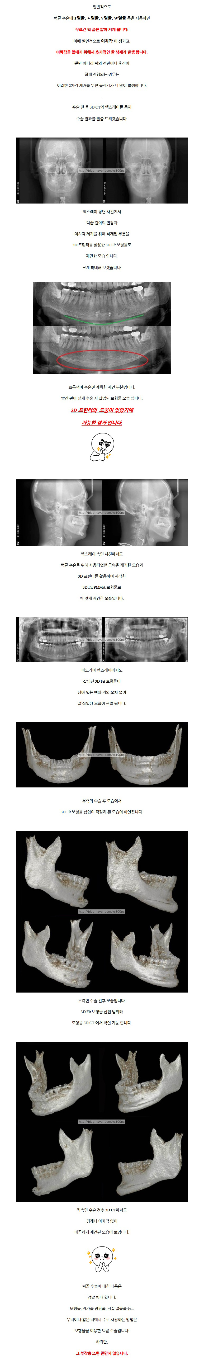 턱재수술.jpg