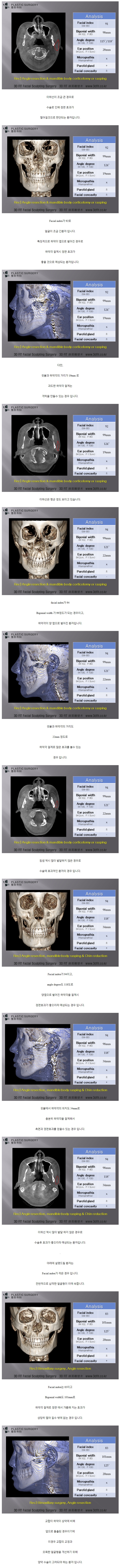 사각턱축소술.jpg