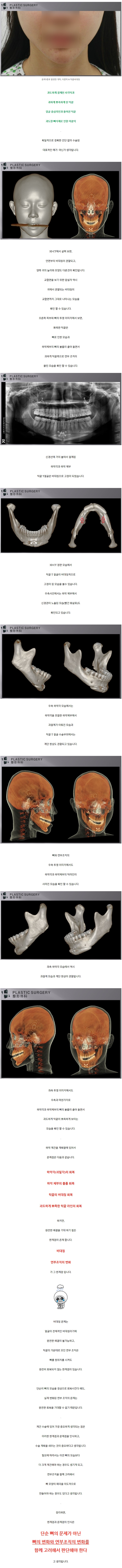 사각턱재건수술.jpg