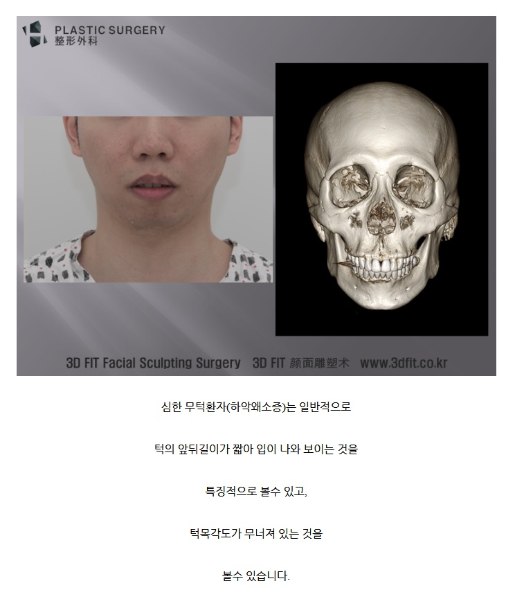 무턱.jpg